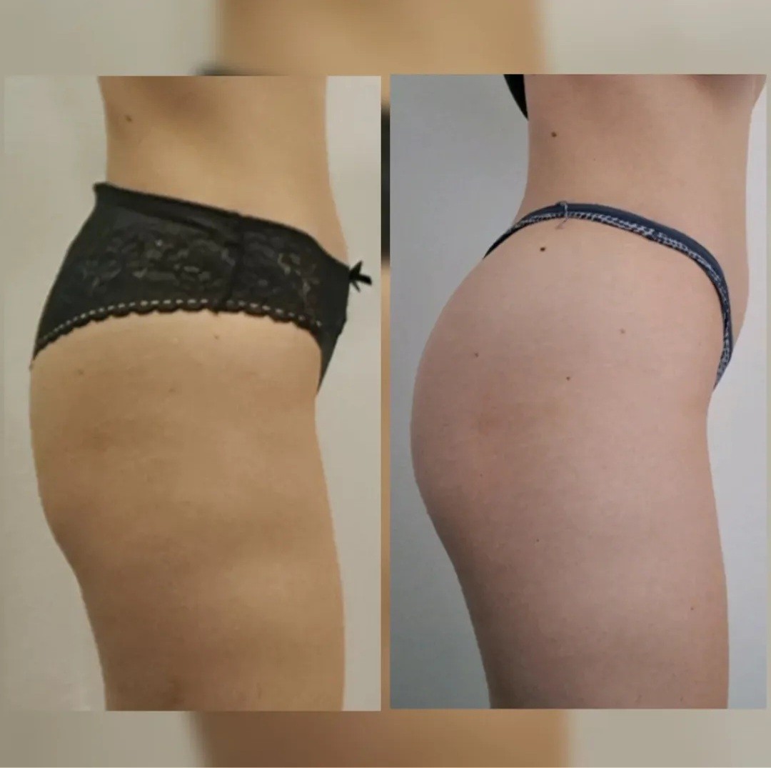 Posh Palace #velika-gorica Tretmani tijela Tesla tretman -EMS+RF NEO - 1 tretman