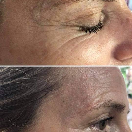 Antiage beauty room Lady Goga #zagreb Tretman lica