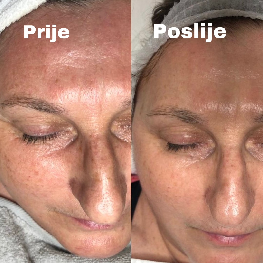 FeelUnique #zagreb Tretman lica Phyto Fenol Peel - tretman diskoloracije kože