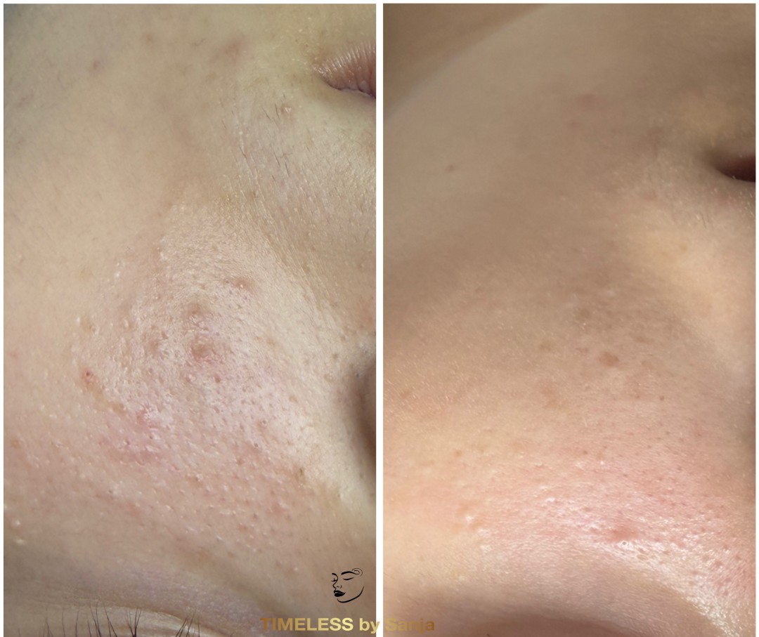 Timeless by Sanja #zagreb Piling lica Mesoestetic peeling