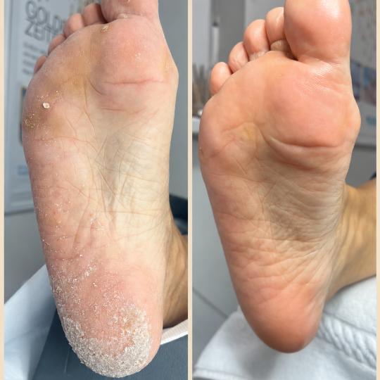 Pedi Feet studio Laura #zagreb Medicinska pedikura Medicinska pedikura - prvi stupanj Medicinska ped