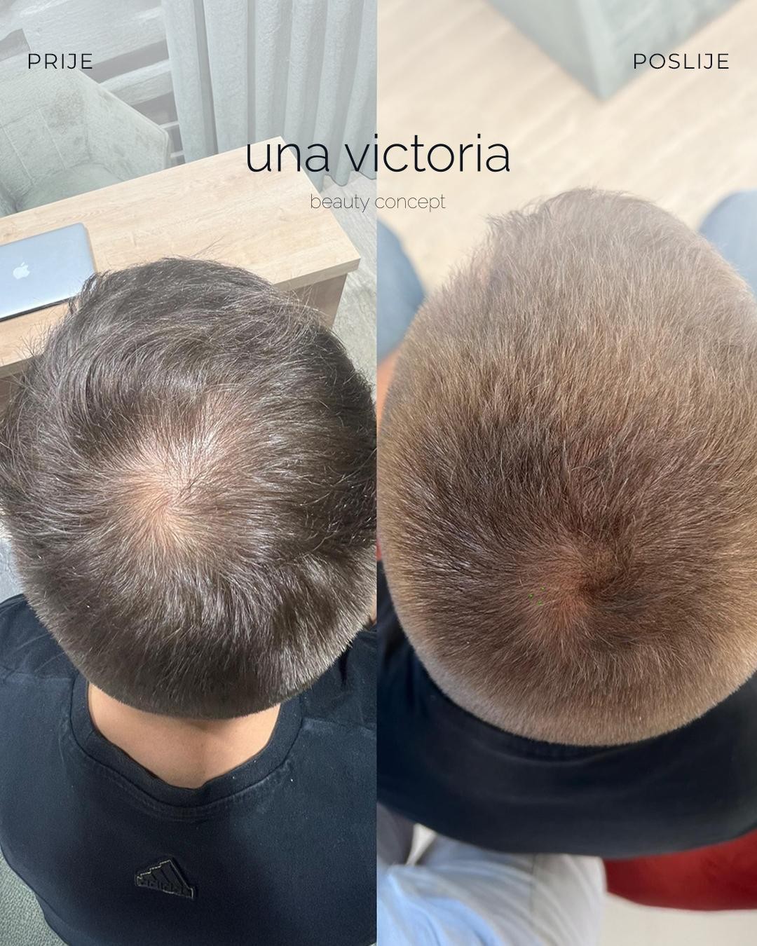 Una Victoria beauty concept #zadar Tretman rasta kose Tretman laserom za poticanje rasta kose
