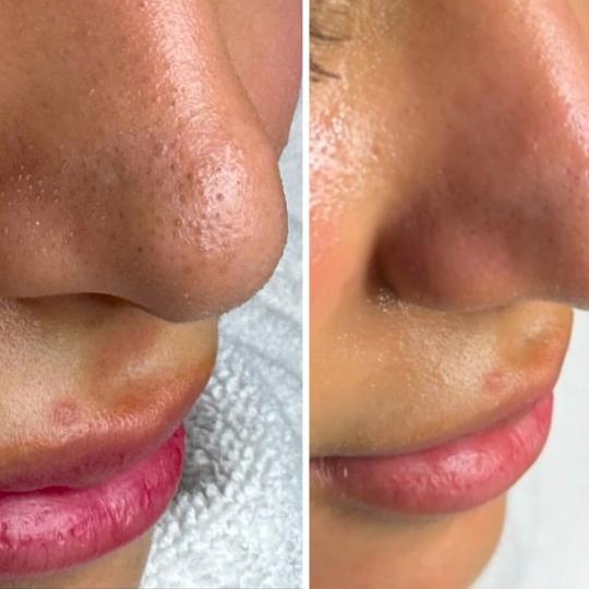 Perfect body beauty bar #zagreb Tretman lica Deluxe hydrafacial tretman lica DELUXE HYDRAFACIAL

*