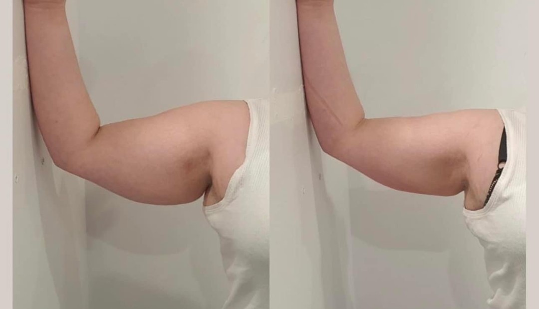 Estetix centar #zagreb Tretmani tijela Elektrostimulacija tijela - paket od 4 tretmana