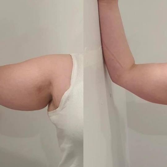 Estetix centar #zagreb Tretmani tijela Elektrostimulacija tijela - paket od 4 tretmana ✅Odradili s