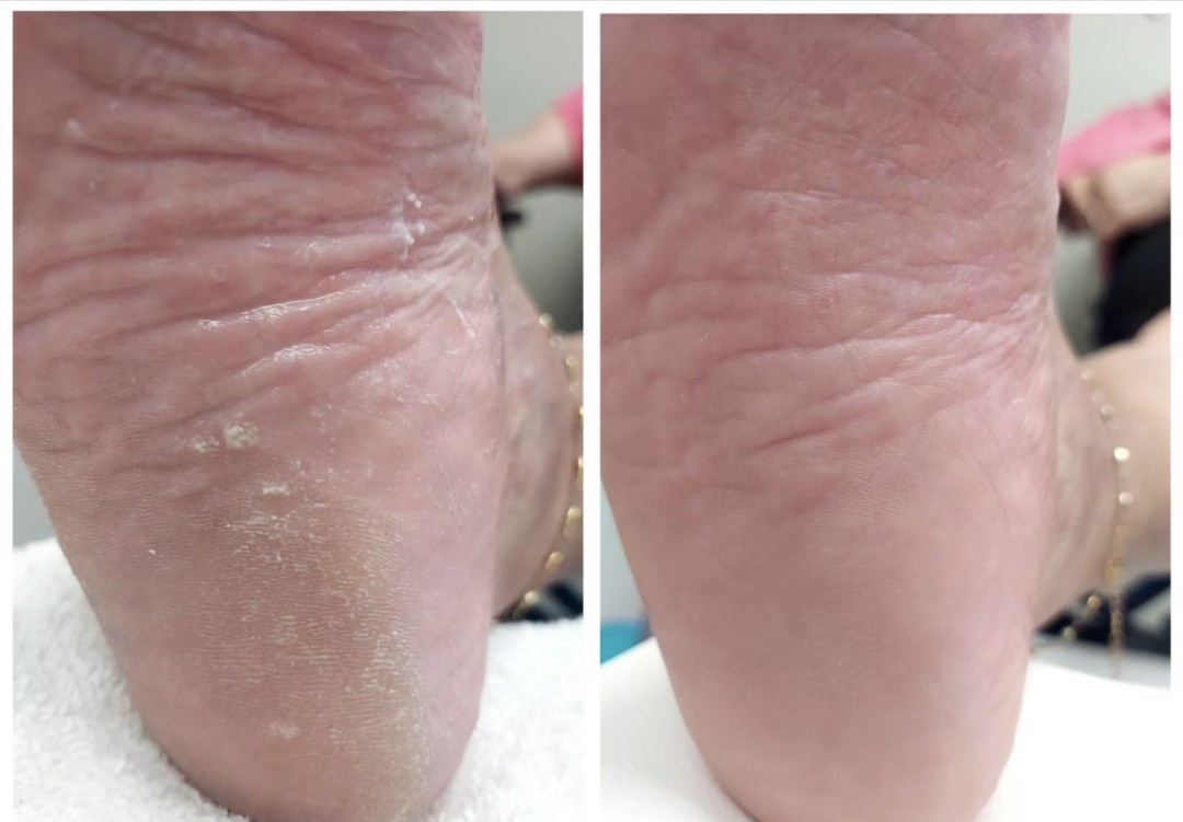 Val beauté #zagreb Medicinska pedikura Medicinska pedikura