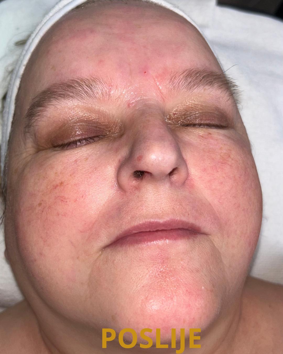 Evi #zagreb Tretman lica Hidrafacial dubinski tretman lica - glam oxy tretman