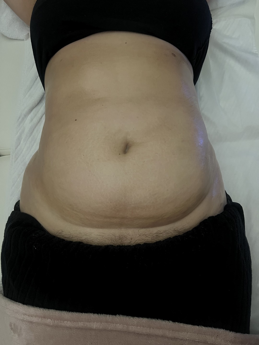 Cleopatra #zagreb Kavitacija Kavitacija + radiofrekvencija tijela - paket od 5 tretmana