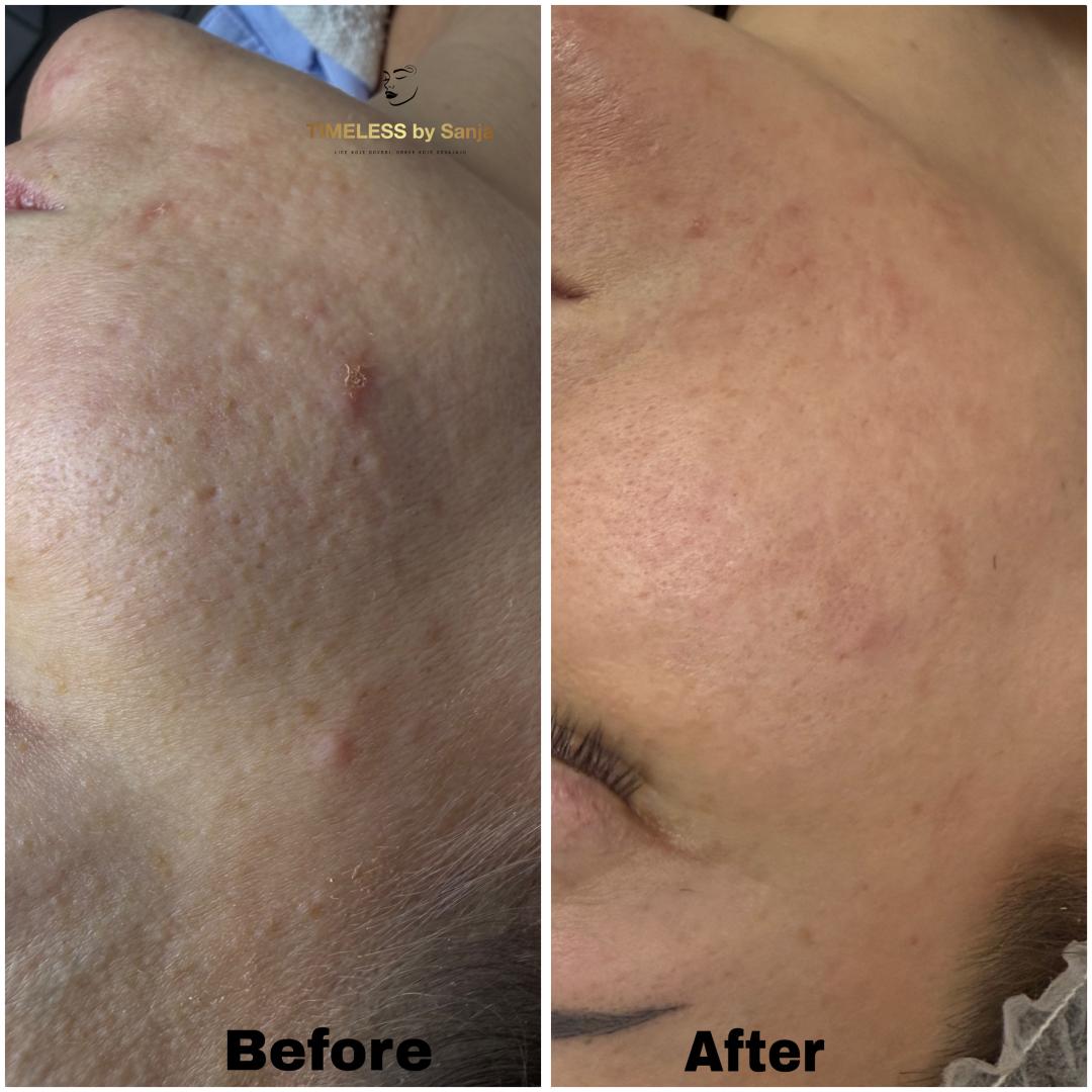 Timeless by Sanja #zagreb Mezoterapija lica Mesoestetic peeling koktel