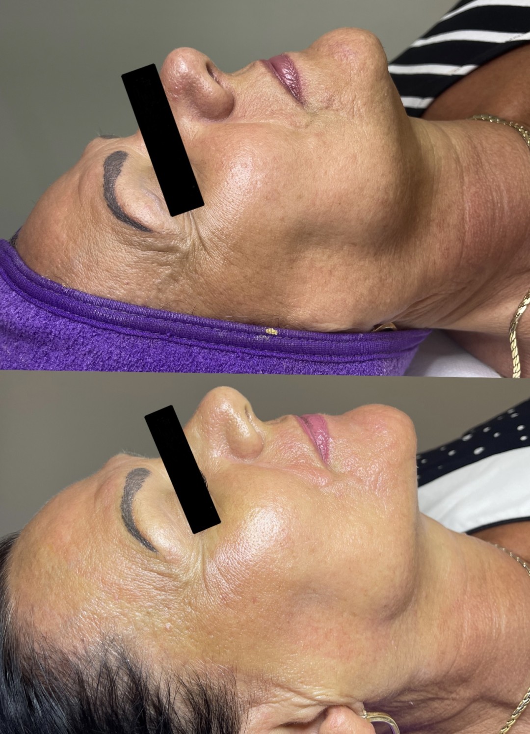 Aktivator pen casmara - Jana, Zadar Tretman lica Lice Tretman lica, Zadar, Centar