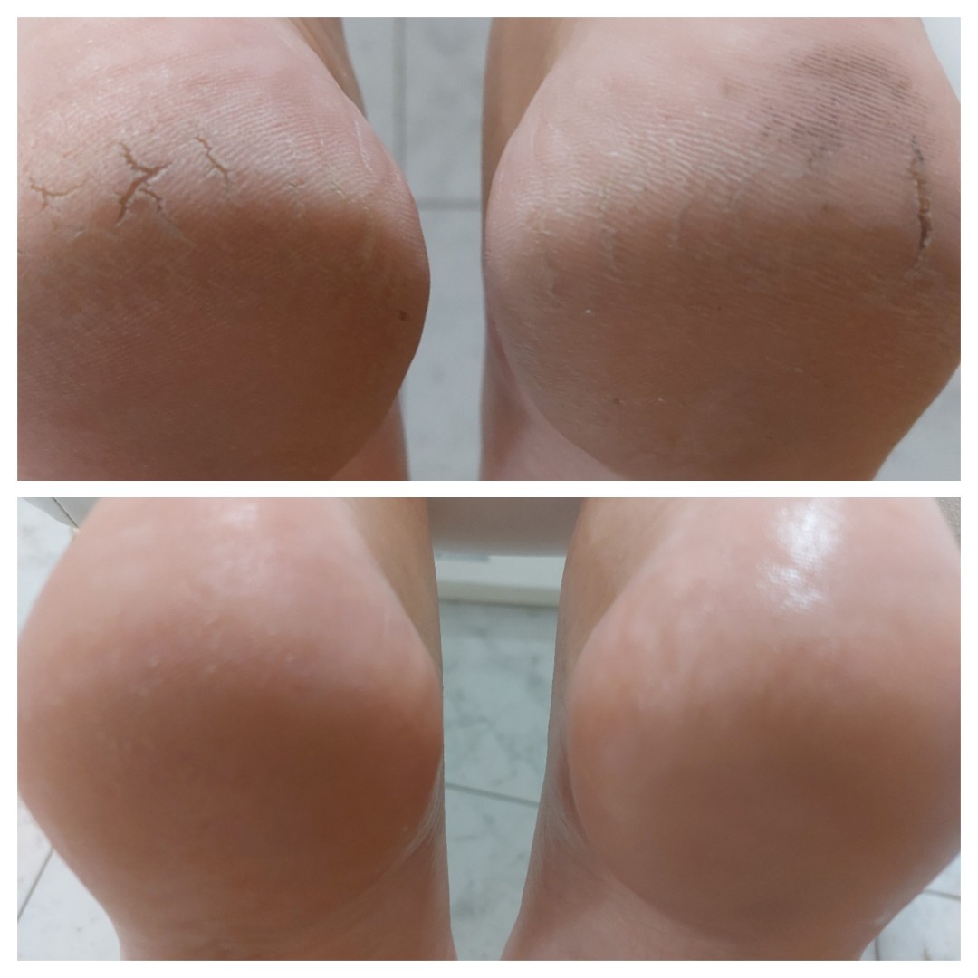 Antiage beauty room Lady Goga #zagreb Medicinska pedikura Pedikura problematičnog stopala