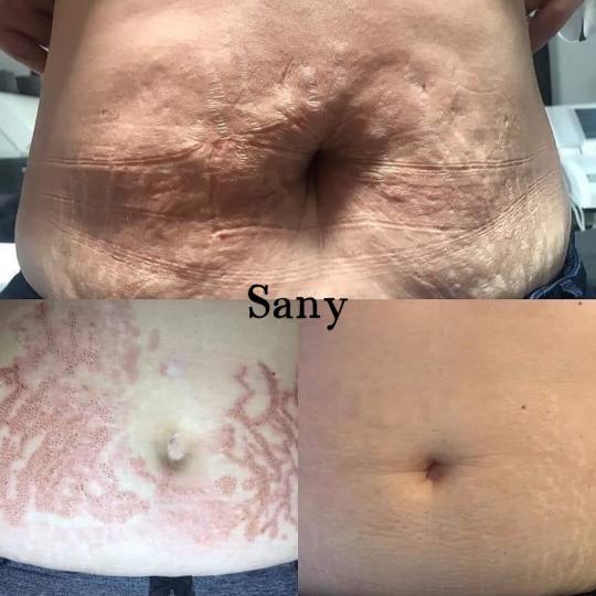 Sany Nails & Cosmetics #zagreb Tretman lica  ACCOR Cosmetics Corrector je nježna alternativa operac