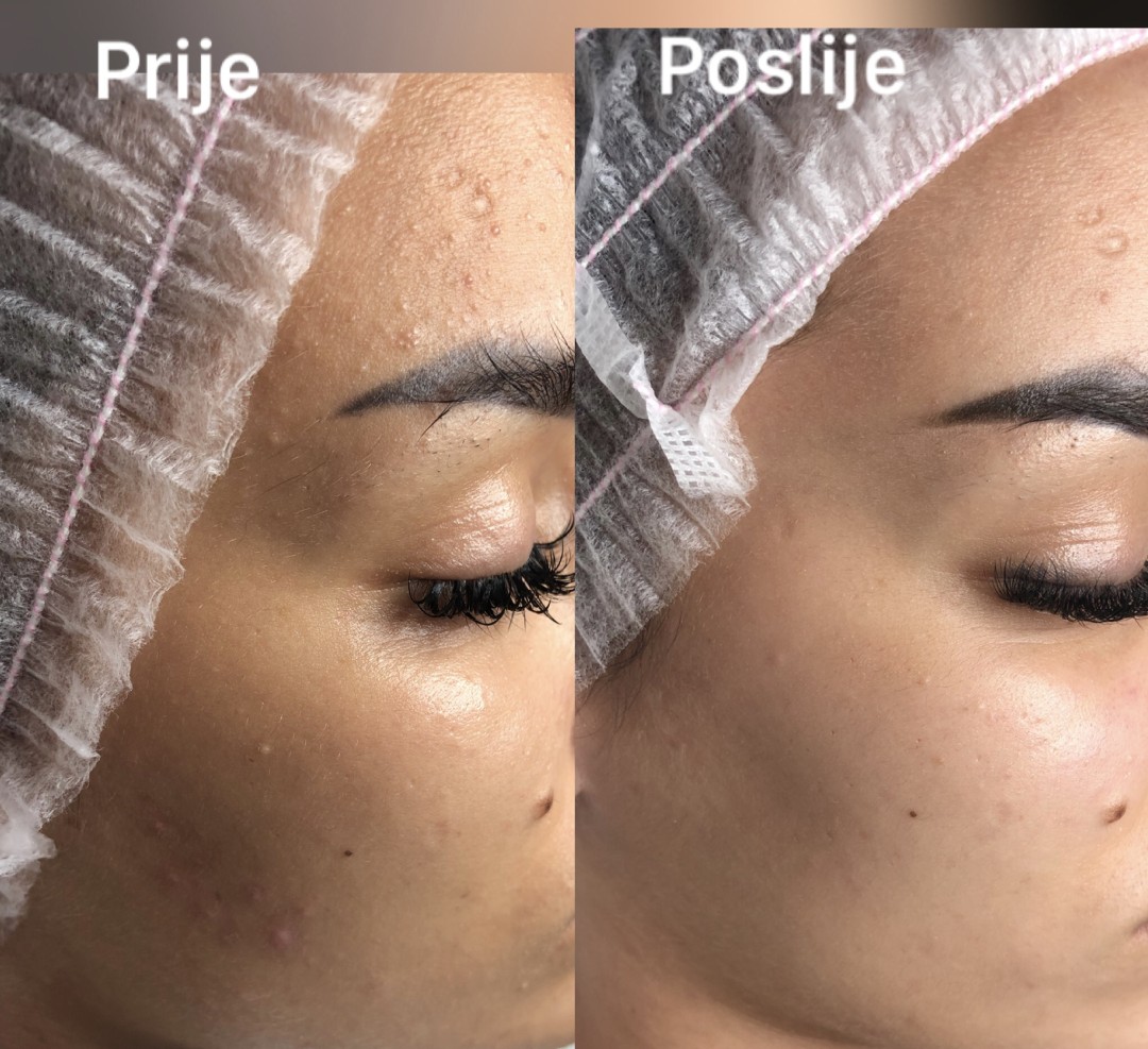 FeelUnique #zagreb Tretman lica Azac - tretman za masnu kožu sklonu aknama