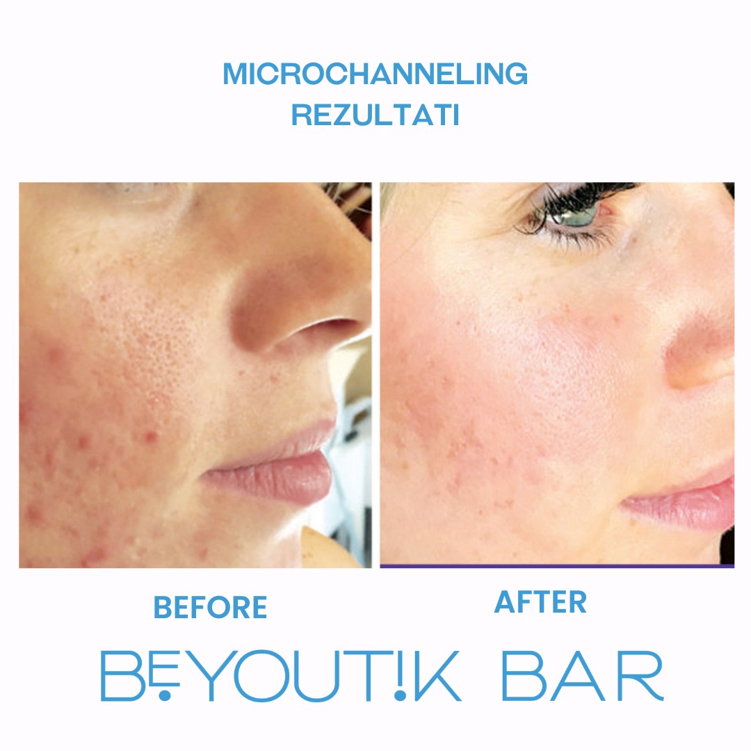 BeYoutik Bar #zagreb Tretman lica Microchanneling - lice