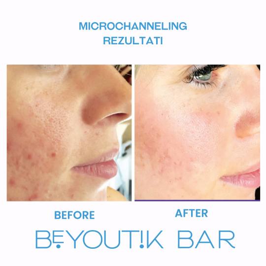BeYoutik Bar #zagreb Tretman lica Microchanneling - lice Rezultati nakon samo 1 tretmana. 
*Napomen