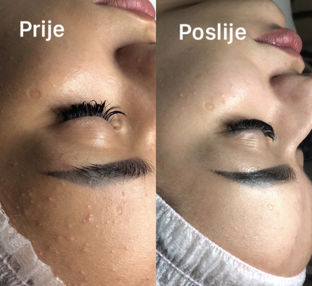 FeelUnique #zagreb Tretman lica Azac - tretman za masnu kožu sklonu aknama