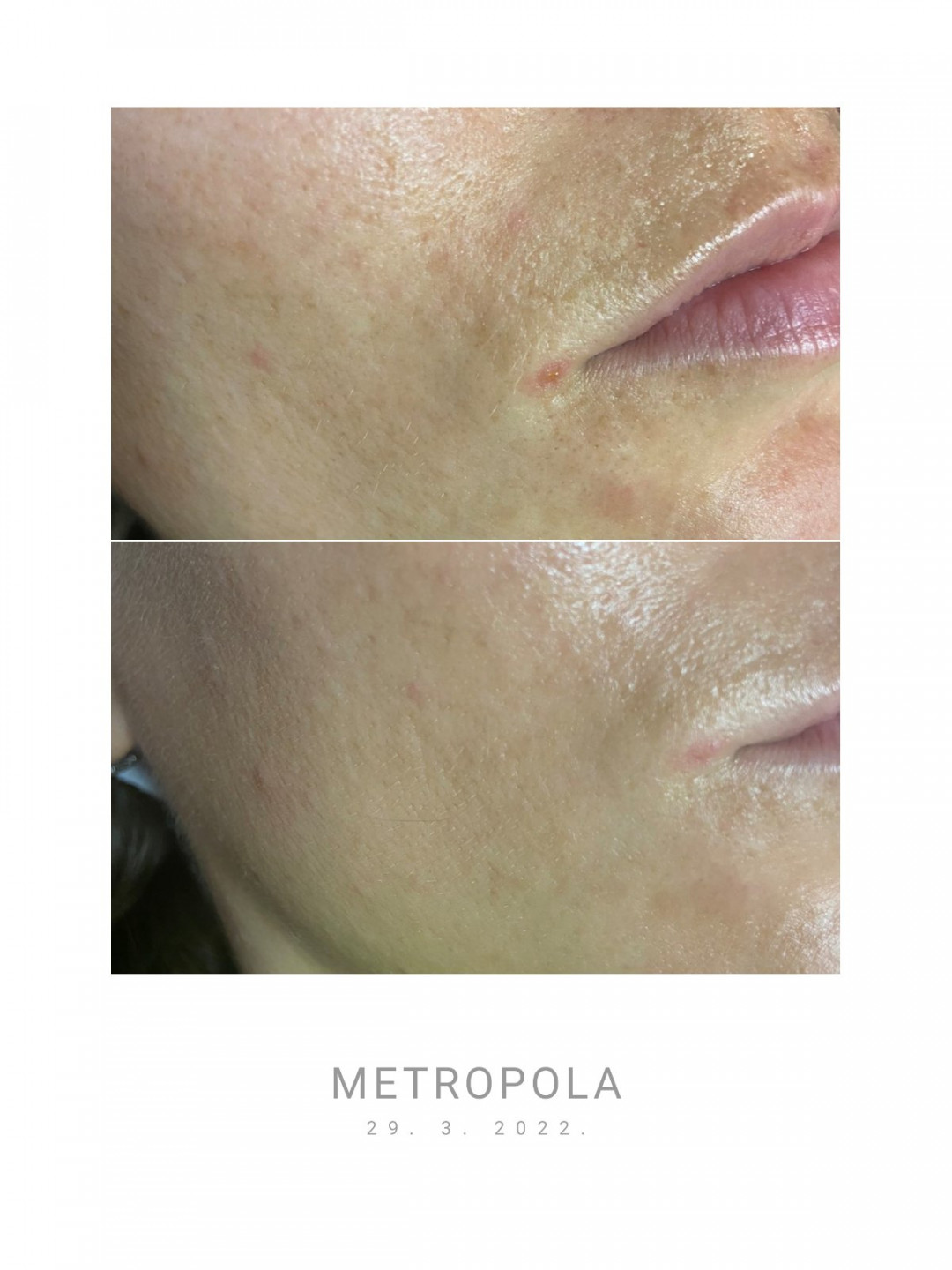 Loops #viskovo Piling lica Probiome Peel (višeslojni kemijski piling)