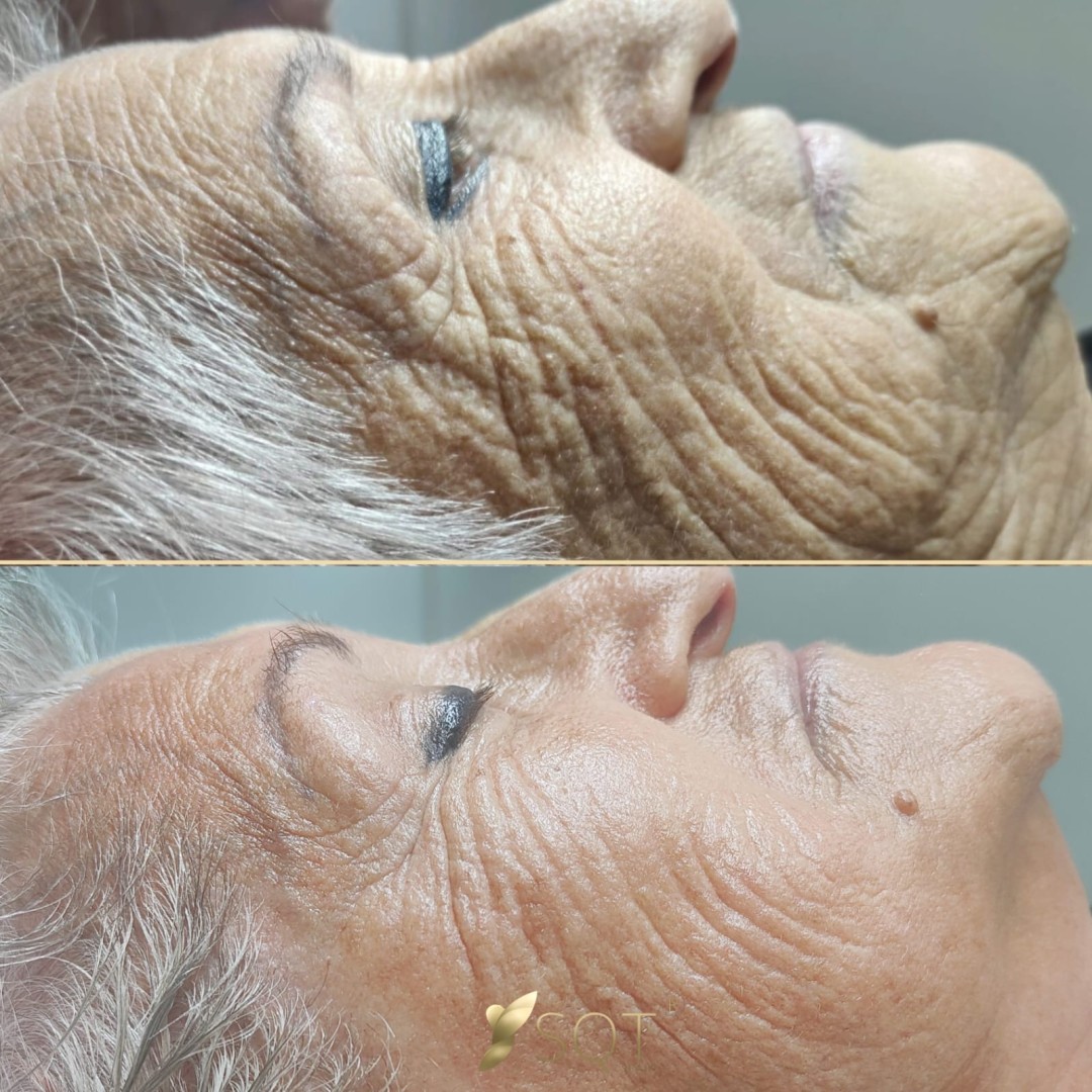 Luma Medic #zagreb Tretman lica SQT nourishing