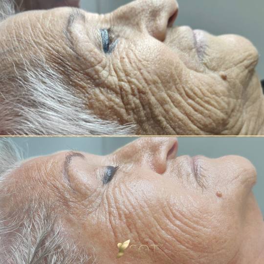 Luma Medic #zagreb Tretman lica SQT nourishing x1 tretman 30 dana nakon