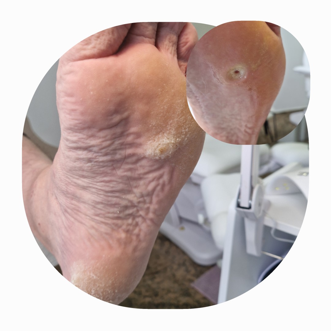 Maja #zagreb Medicinska pedikura