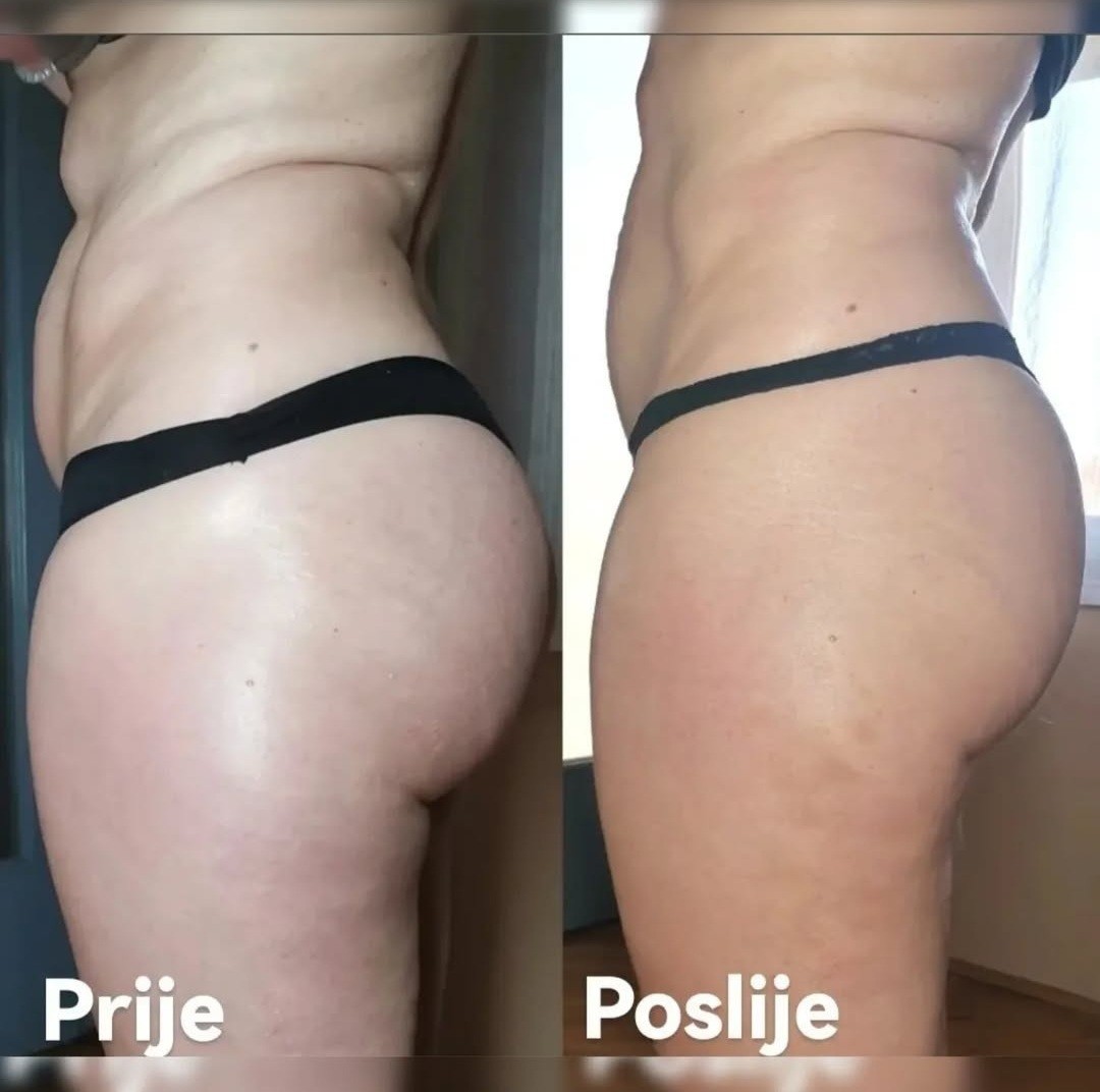 Posh Palace #velika-gorica Tretmani tijela Brazilska maderoterapija - cijelo tijelo