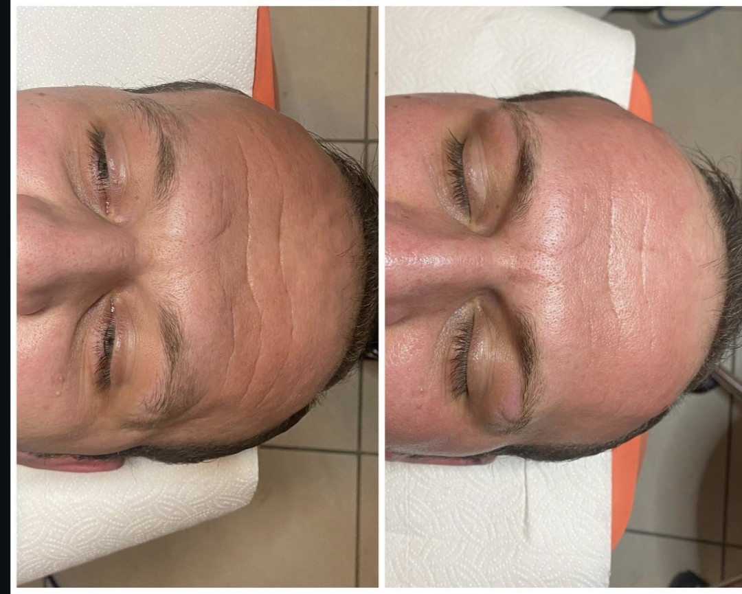 Nefertiti Studio #zagreb Mezoterapija lica Microneedling / Derma Pen lica