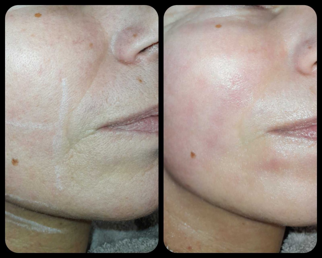 Natural #rijeka Tretman lica HIFU tretman lica