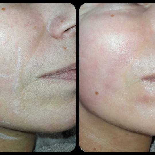 Natural #rijeka Tretman lica HIFU tretman lica