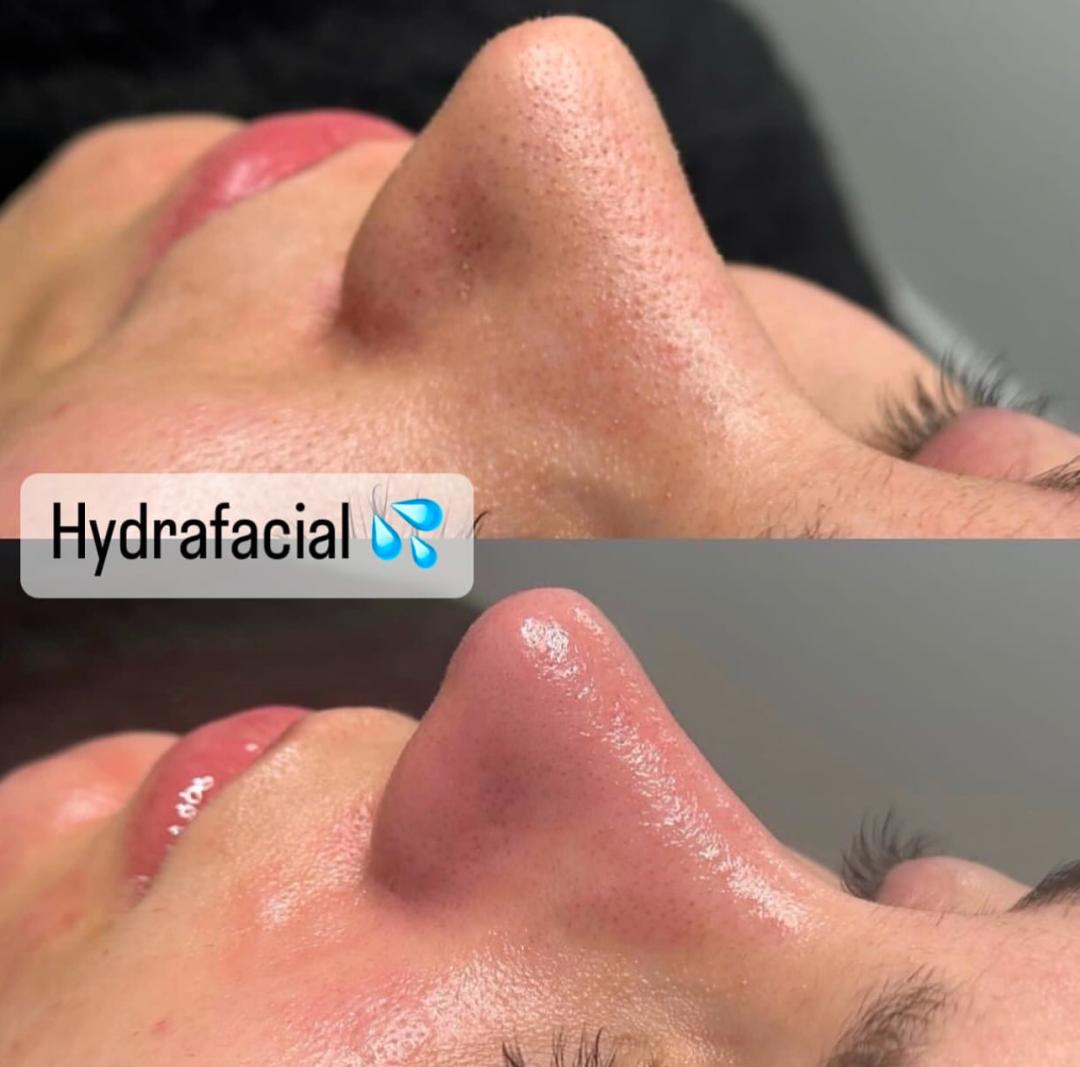 Perfect body beauty bar #zagreb Tretman lica Deluxe hydrafacial tretman lica