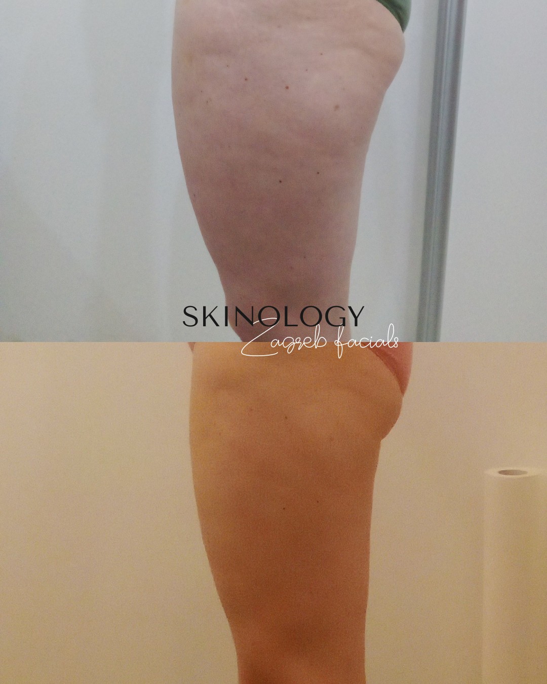 Skinology Zagreb facials #zagreb Tretman lica LPG aparativni anticelulitni tretman - paket od 10 tretmana + 1gratis