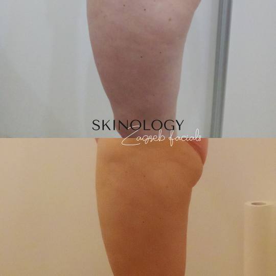 Skinology Zagreb facials #zagreb Tretman lica LPG aparativni anticelulitni tretman - paket od 10 tre