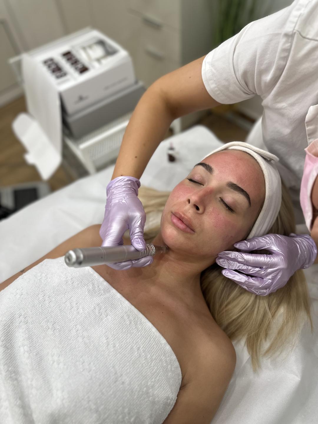 Beauty Box - Zagreb #zagreb Tretman lica Microneedling