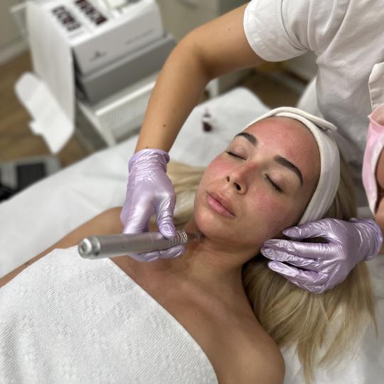 Beauty Box - Zagreb #zagreb Tretman lica Microneedling