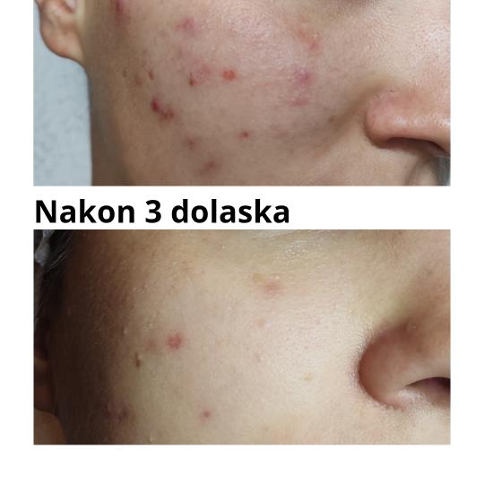 Valena estetica #zagreb Tretman lica Mehaničko čišćenje lica Stanje kože lica prije prvog tretm