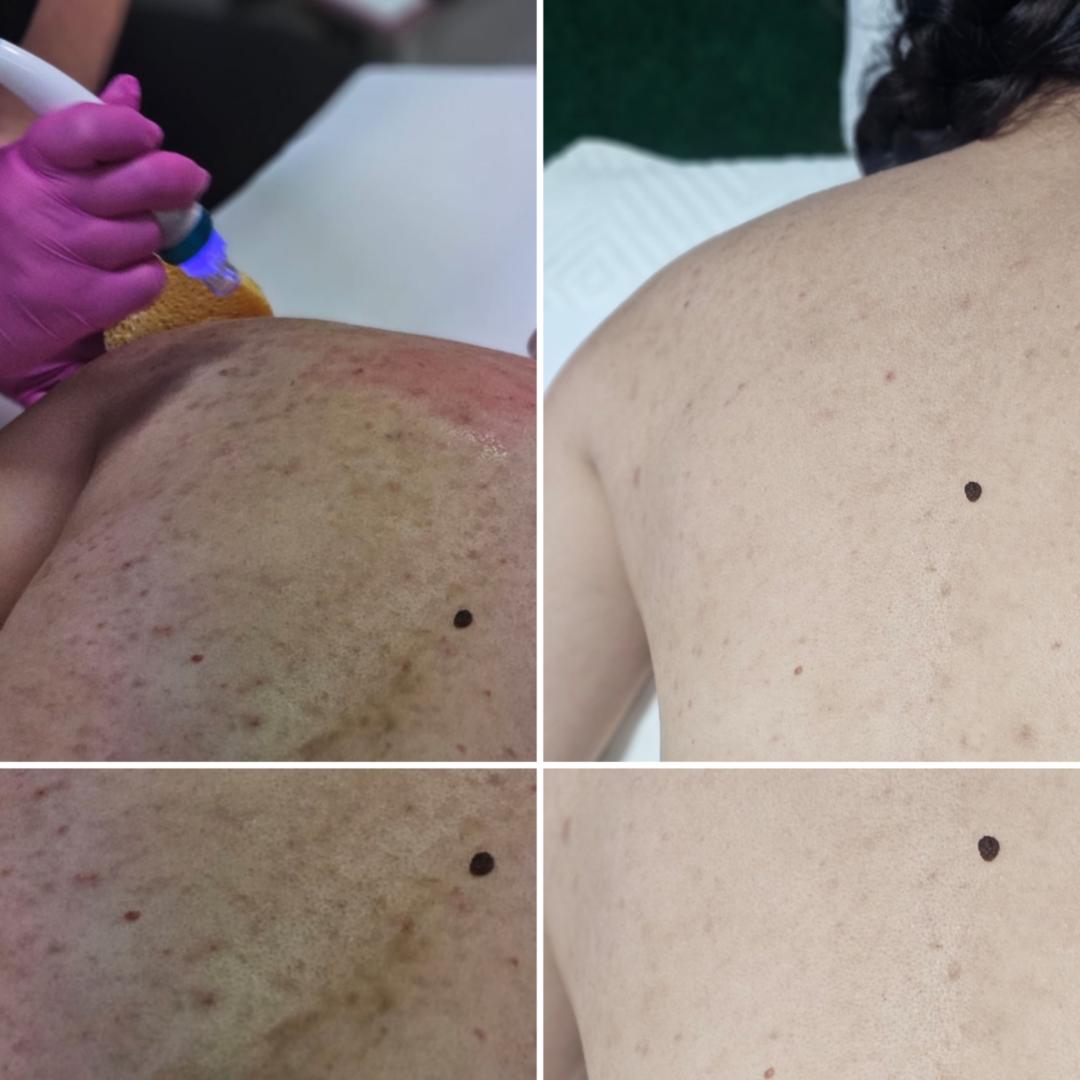 S M Beauty Bloom #zadar Laserski tretmani lica Black peel - tretman lica