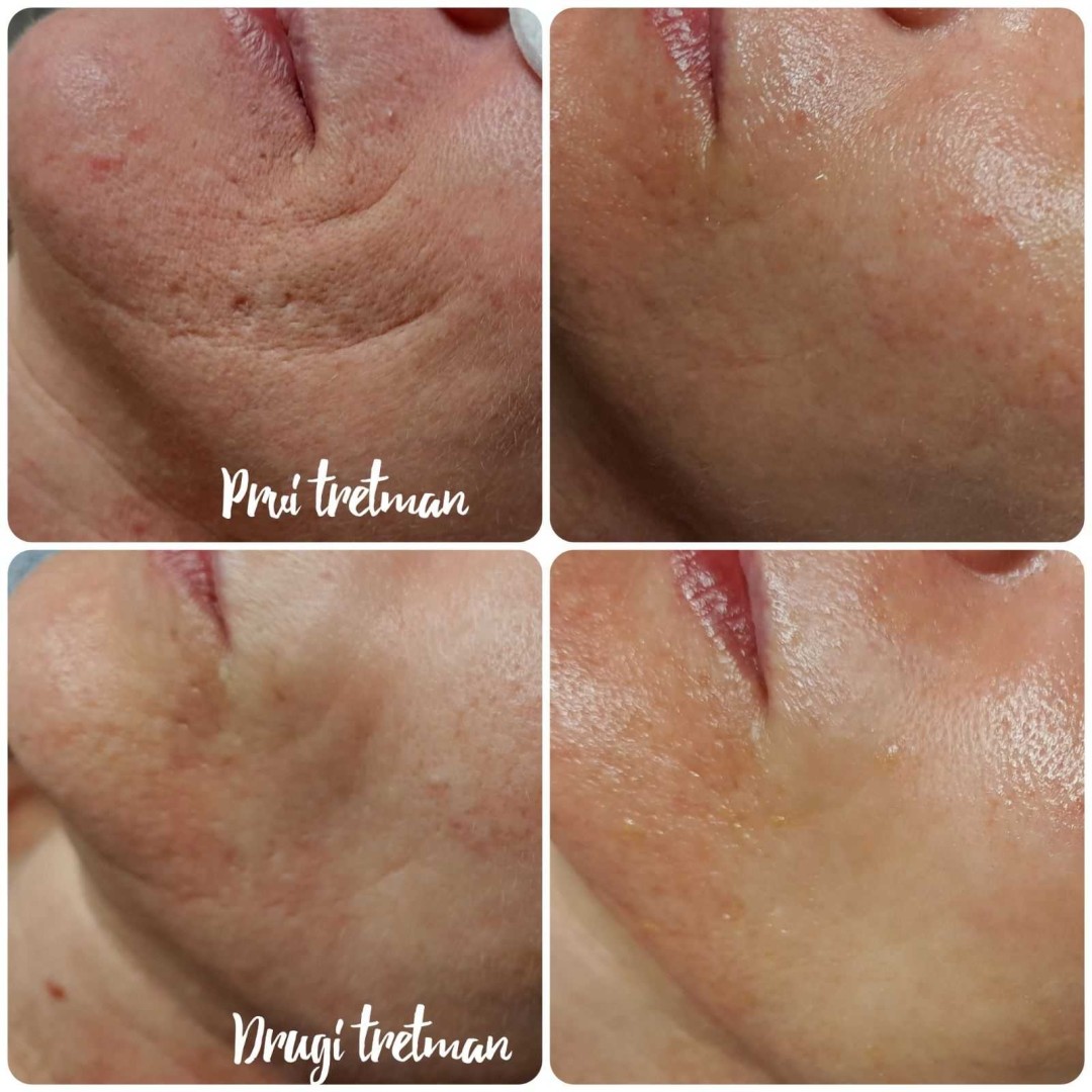 Natural #rijeka Tretman lica Kolagen niti - cijelo lice