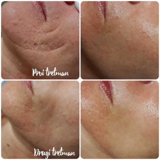 Natural #rijeka Tretman lica Kolagen niti - cijelo lice rezultati tretmana kolagen nitima