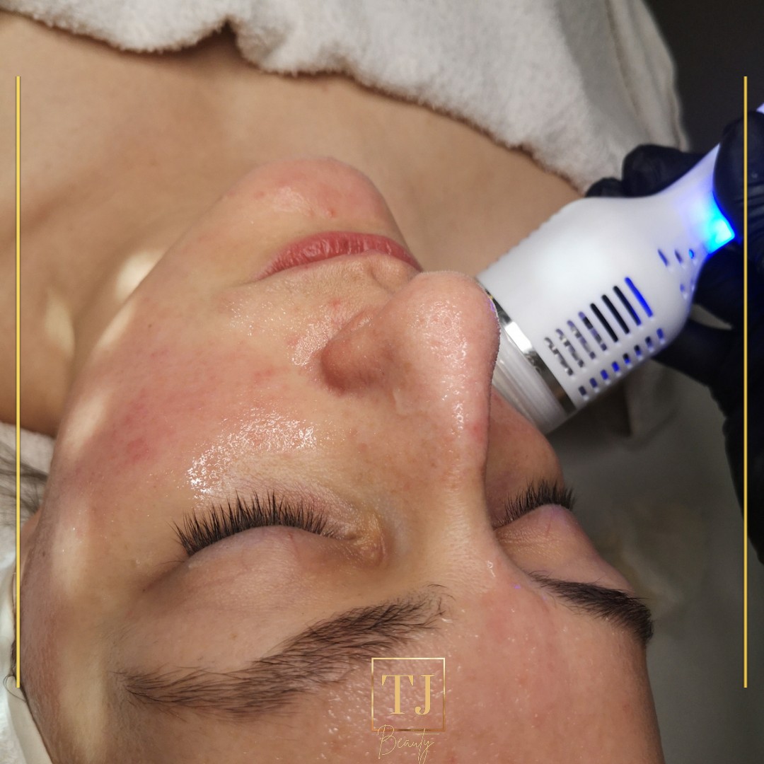 TJ Beauty #zagreb Tretman lica Hydrafacial tretman lica + oxy ampula + radiofrekvencija