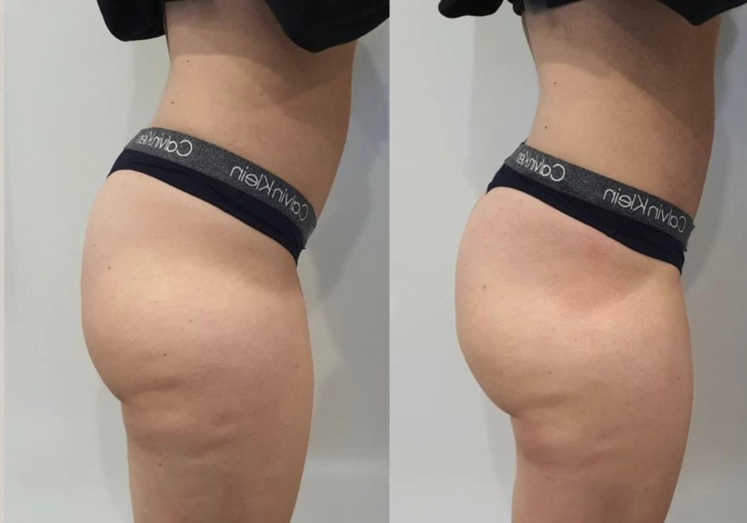 Estetix centar #zagreb Tretmani tijela Nekirurško podizanje gluteusa vakuumom - paket od 4 tretmana