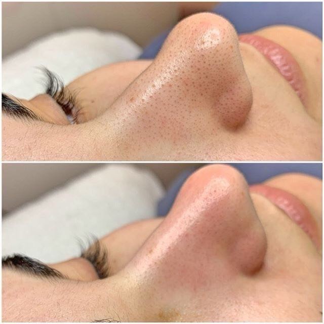 Hydrafacial tretman lica - Beauty kraljica, Zagreb Tretman lica Lice Tretman lica, Zagreb, Stenjevec