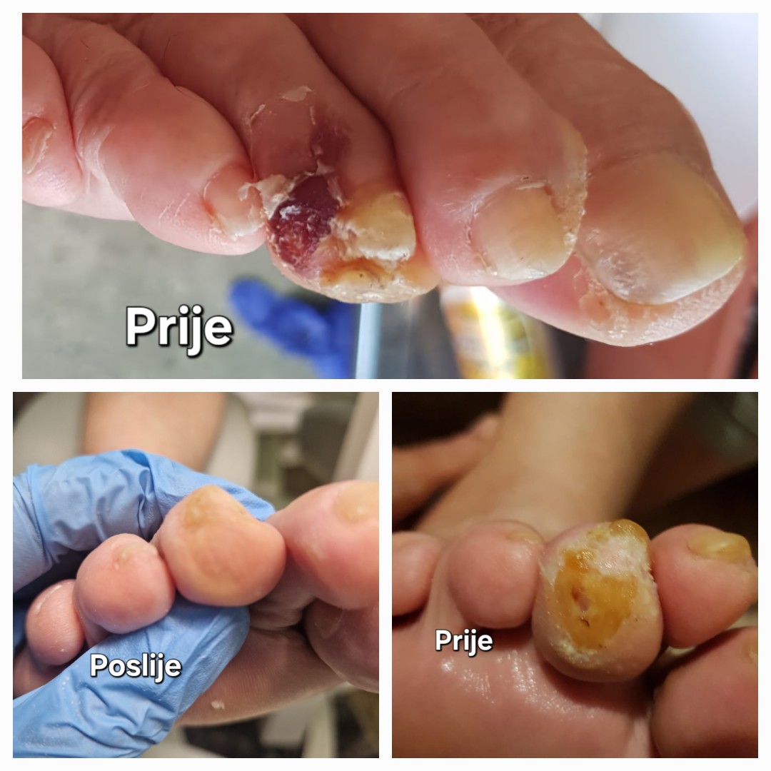 Maja #zagreb Medicinska pedikura Medicinska pedikura i lakiranje noktiju