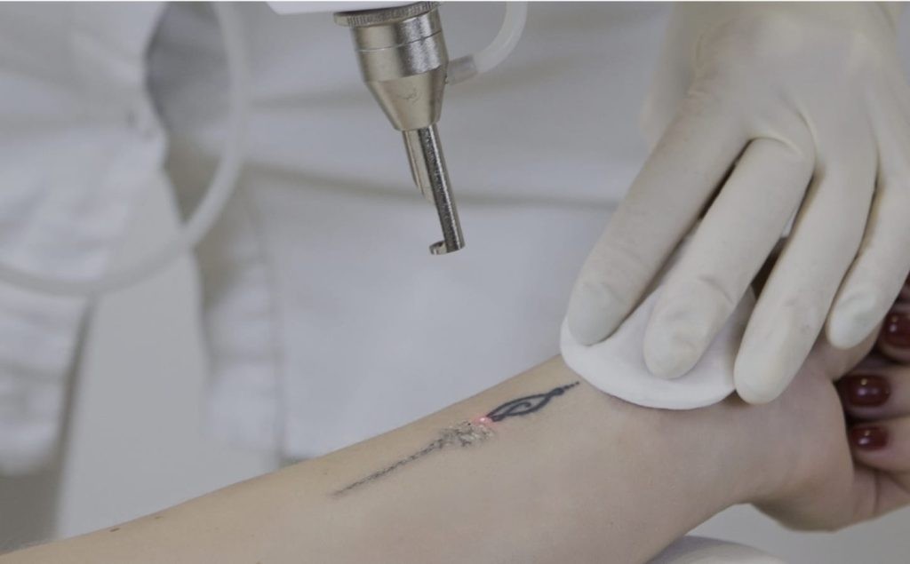 SOLO Beauty Centar #zagreb Uklanjanje tetovaža Pico laser - uklanjanje tetovaže - veličina 10x10 cm