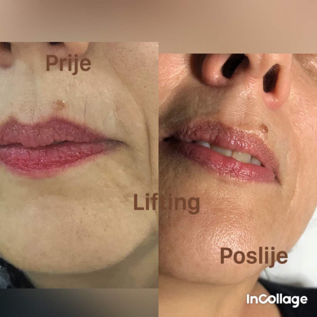 FeelUnique #zagreb Tretman lica Nana i Gaba lift therapy + microneedling - lifting / pomlađivanje