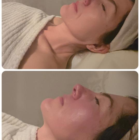 Transform touch #varazdin Pomlađivanje lica prirodnom metodom