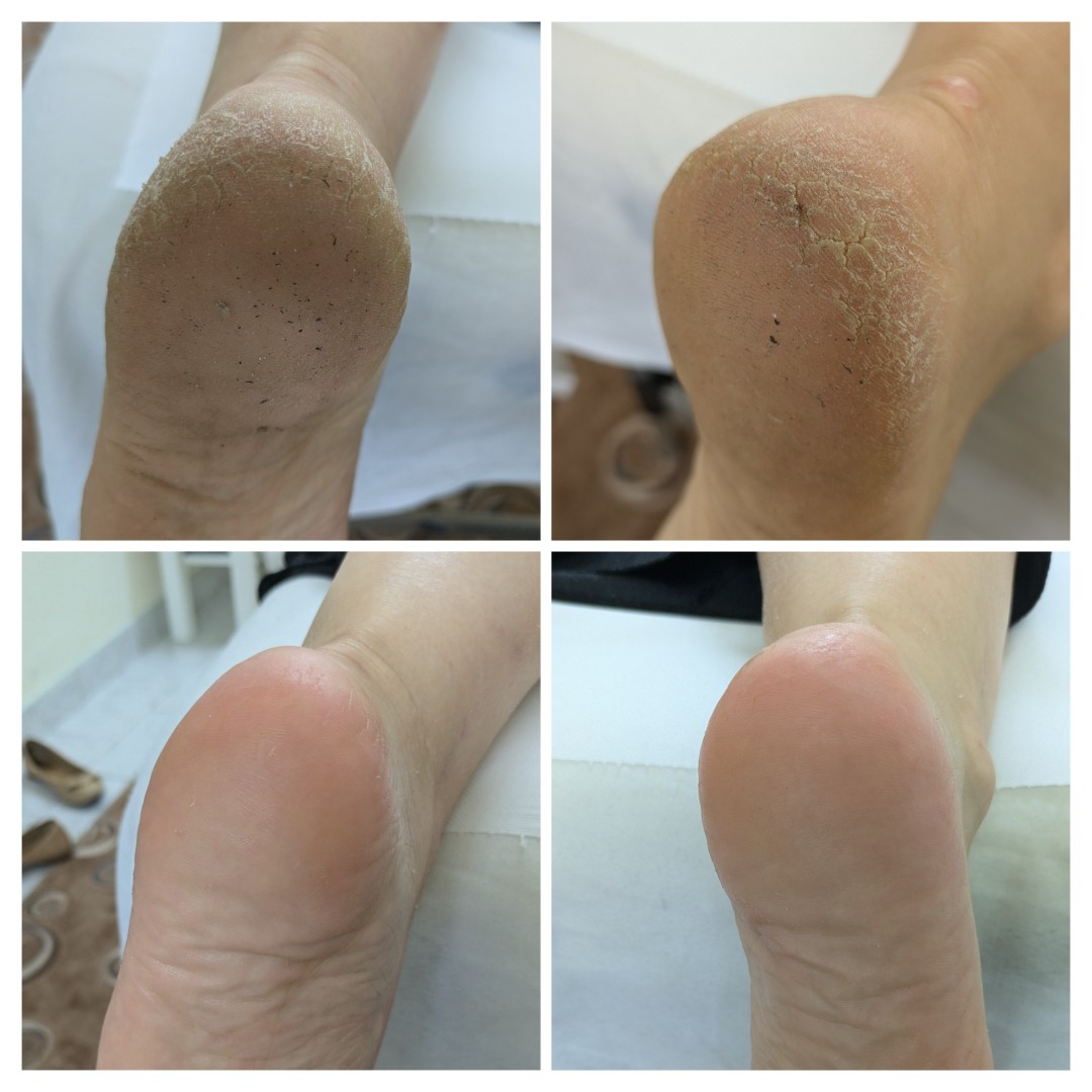 Gelaxy x Motus #zagreb Estetska pedikura Suha ruska pedikura + callux tretman