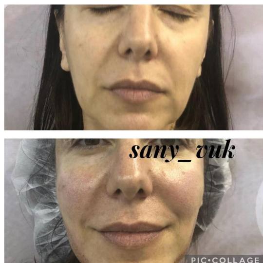 Sany Nails & Cosmetics #zagreb Tretman lica  ACCOR Cosmetics Corrector je nježna alternativa operac