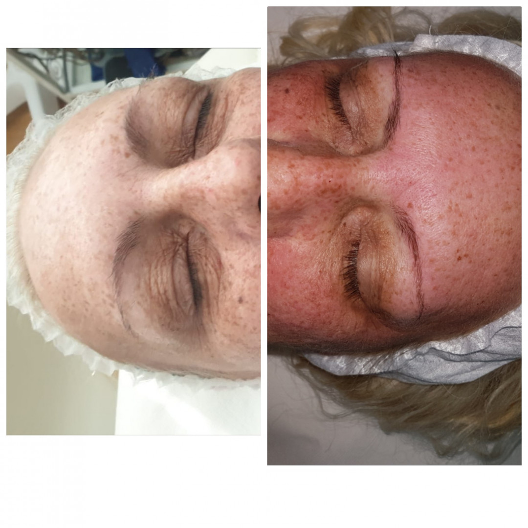 Melanis i Silueta studio za njegu lica i tijela #zagreb Tretman lica Mezoterapija lica + dermaroler - 5 tretmana