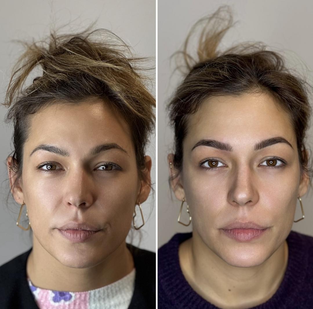 Puder obrve (sa korekcijom nakon 4-6 tjedana) - Anova Aesthetics, Zagreb Trajna šminka Lice Trajna šminka, Zagreb, Trešnjevka – jug