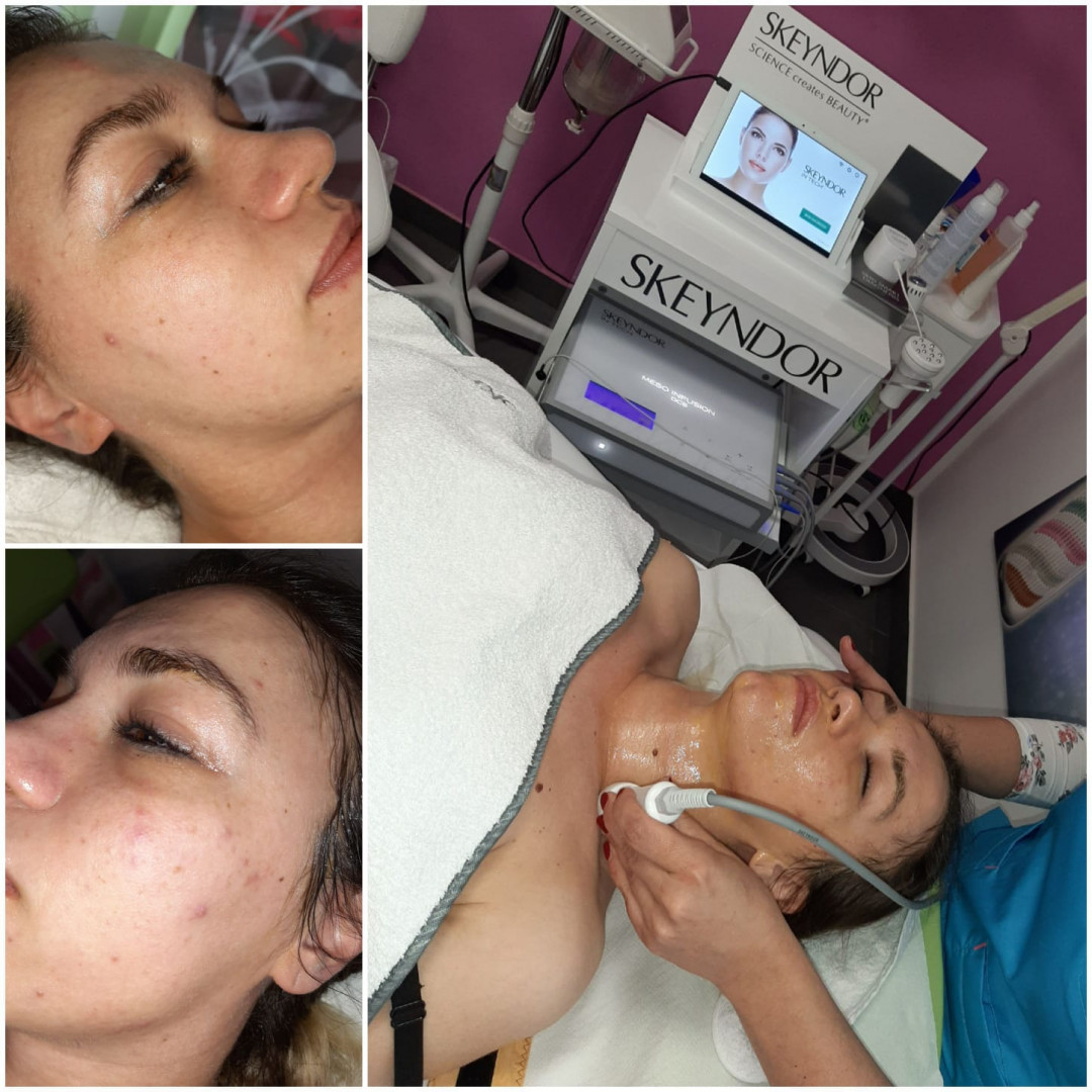 Loops #viskovo Mezoterapija lica Virtualna mezoterapija - Mesofiller