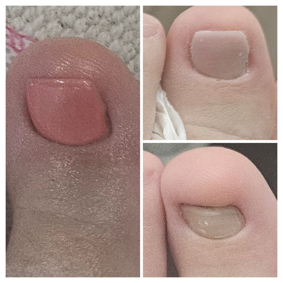 Cosmoderm & Centar Estetica #zagreb Medicinska pedikura Medicinska pedikura + trajni lak - složeni slučajevi